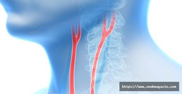 Tıkalı şah damarı kalıcı felcin habercisi olabilir!