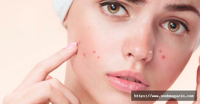 Sivilcesiz Bir Cilt İçin Bilmeniz Gereken 9 Faktör