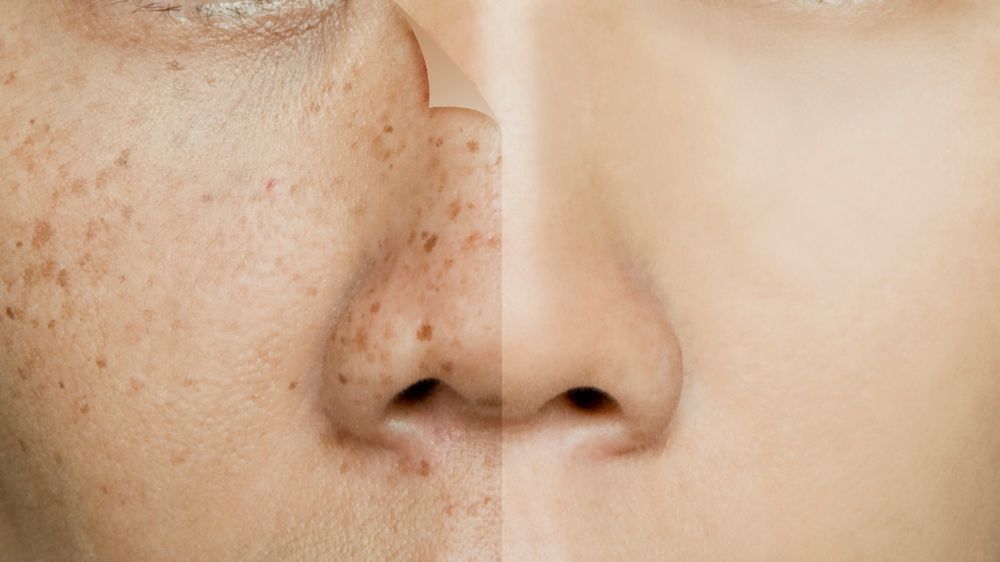 Cilt lekelerinizden korkmayın! Çaresi var