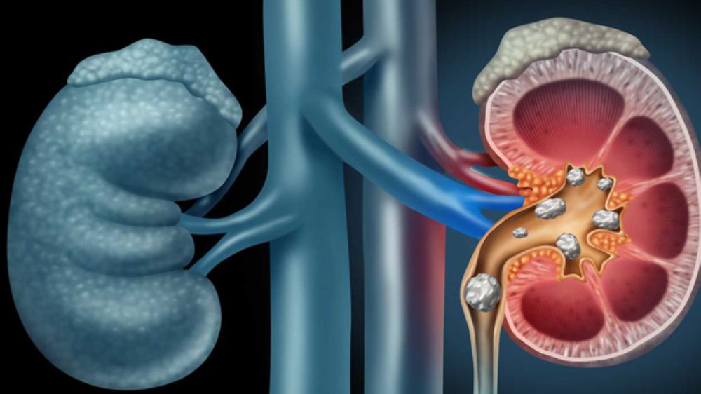  Böbrek taşları lazerle tozlaştırılabiliyor