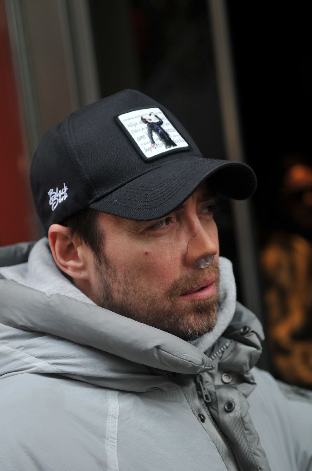 12 kez burun ameliyat olan Murat Dalkılıç, ilk kez süreç hakkında konuştu!