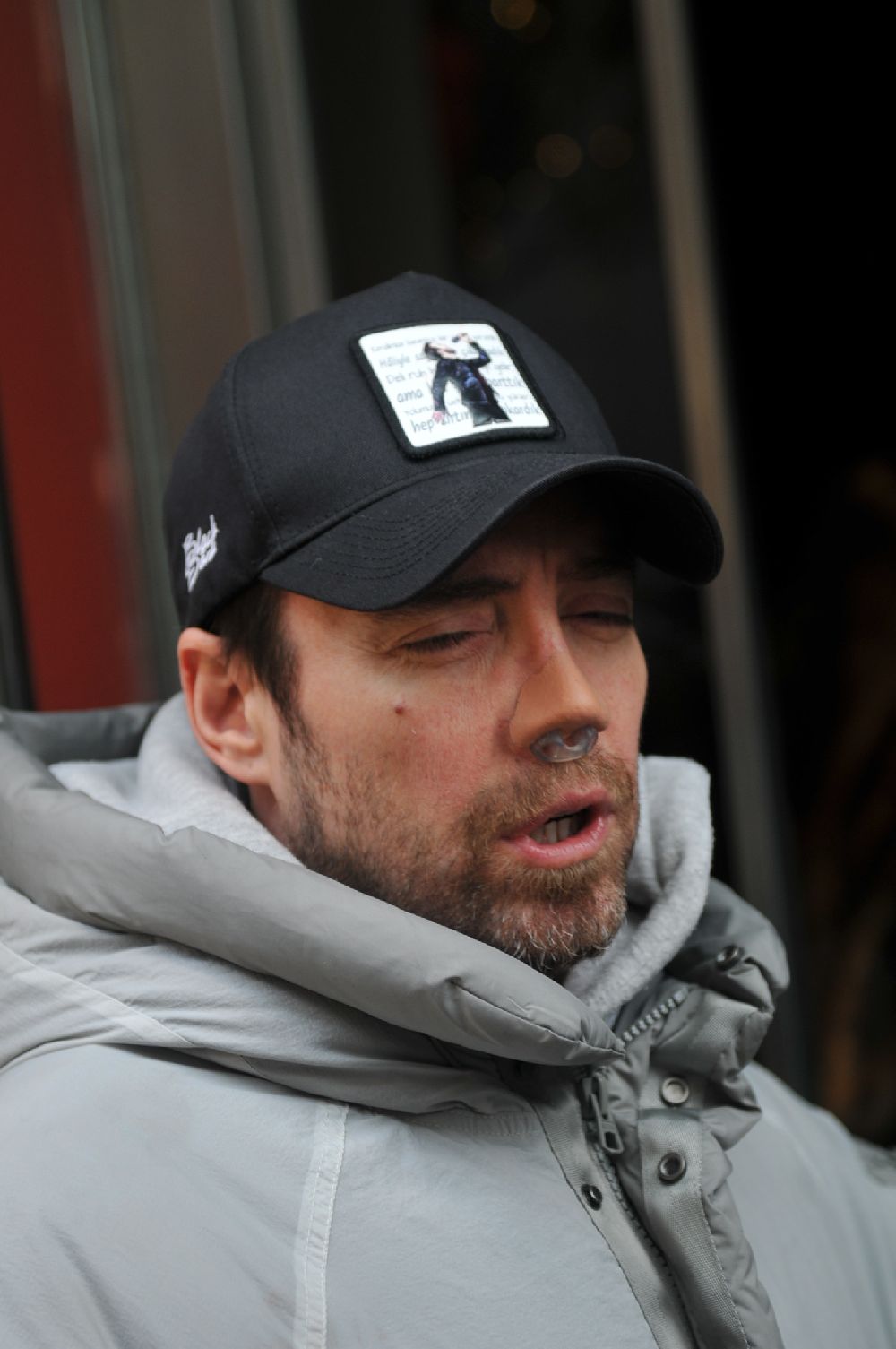 12 kez burun ameliyat olan Murat Dalkılıç, ilk kez süreç hakkında konuştu!