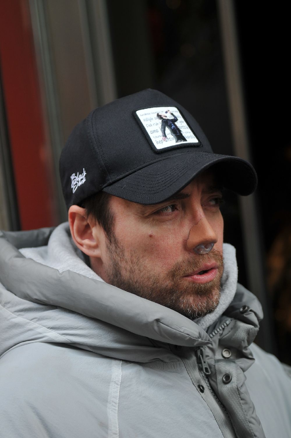 12 kez burun ameliyat olan Murat Dalkılıç, ilk kez süreç hakkında konuştu!