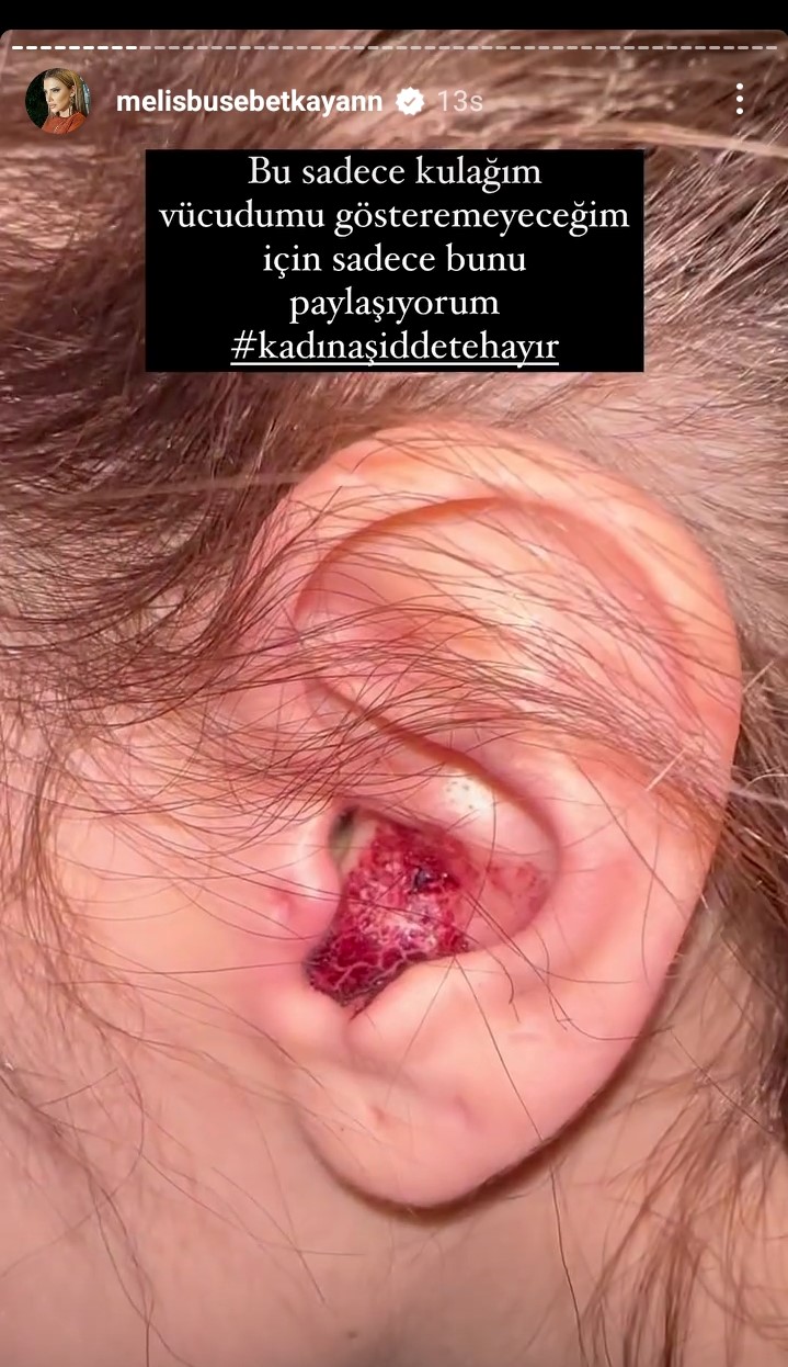 Melis Buse Betkayan Eski Sevgilisinden Şiddet Gördüğünü Söyledi 